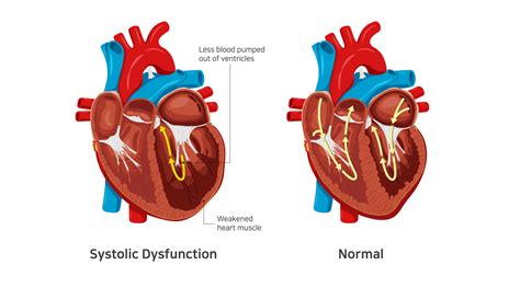 severe lv systolic dysfunction treatment